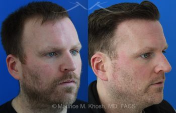FUE Hair Transplant Male Patient before and After Treatment